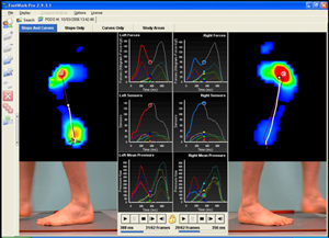 bunions South Woodford