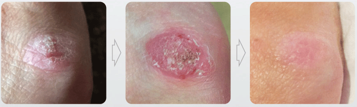 HATFIELD BROAD OAK CRYOSURGERY WART