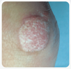 CRYOSURGERY WART Stansted