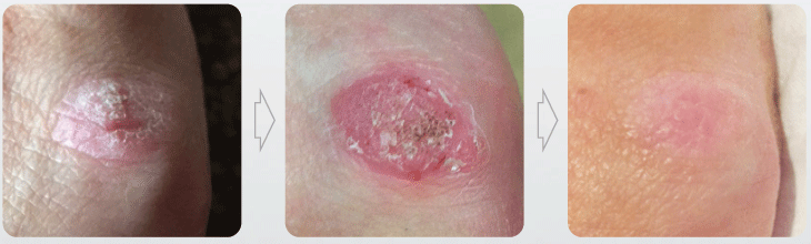 CHIGWELL CRYOTHERAPY WART
