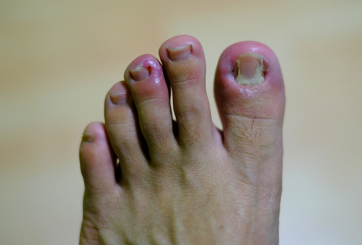 Ingrowing toenail Barnet