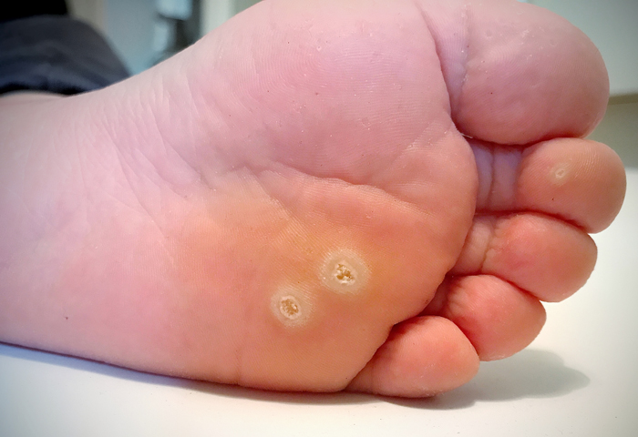 WART TREATMENT Harlow